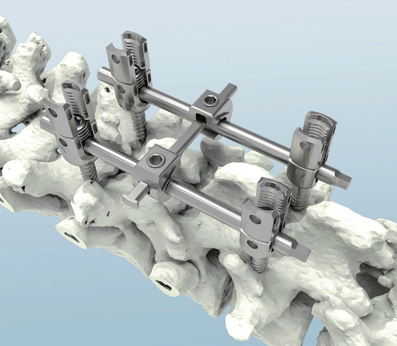 5.5 Spinal Rod Fixation Pedicle Screw System Buy Orthopedic implants